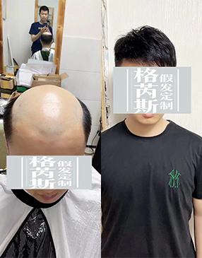 男生增發(fā)可以試試物理增發(fā)織發(fā)補(bǔ)發(fā)產(chǎn)品，這種可以快速增加發(fā)量，達(dá)到密發(fā)效果