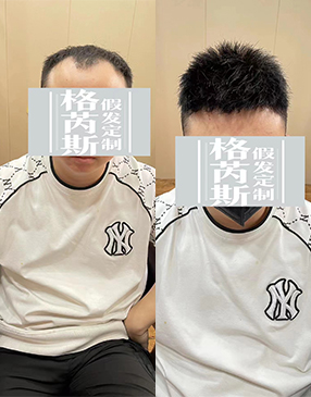 測(cè)量后，與客戶溝通需要定制的樣式造型和發(fā)長(zhǎng)制定，確定補(bǔ)發(fā)方案